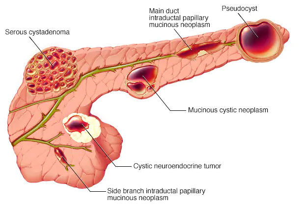 pancreatic_cysts-1.jpg